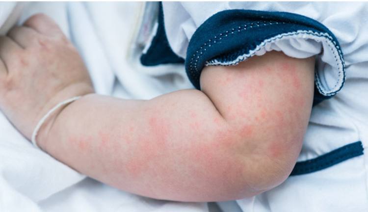 urticaria-in-children-symptoms-causes-and-treatment